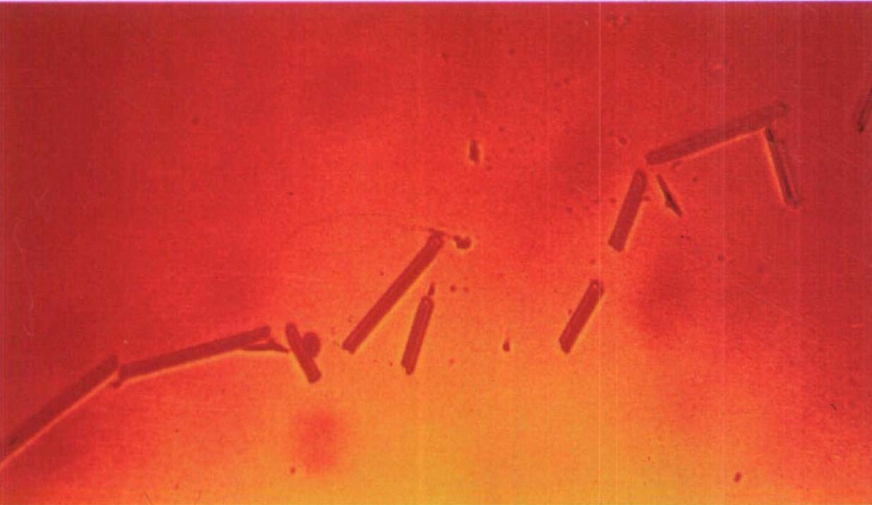 35.普通显微镜下关节液中的尿酸盐针状结晶